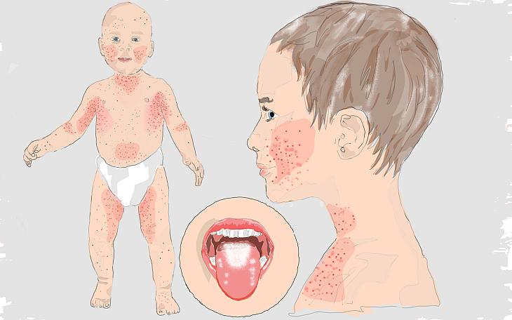 Scharlach als Ursache roter Flecken beim Kind.