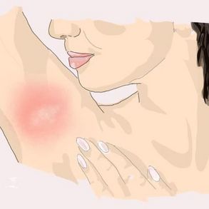 Bienengiftallergie Hautausschlag