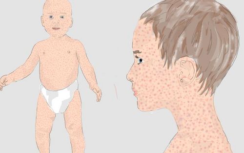 Bild eines Users zum Thema Röteln