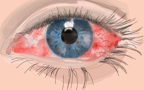 Bild eines Users zum Thema Hornhautentzündung