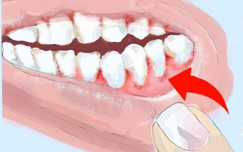 Bild eines Users zum Thema Parodontitis