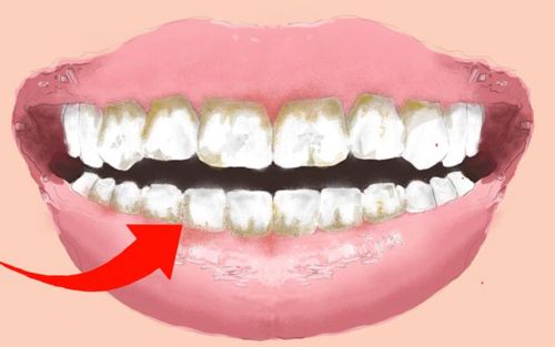 Bild eines Users zum Thema Zahnbelag
