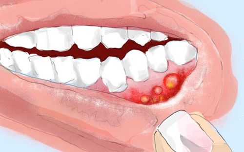 Bild eines Users zum Thema Kieferzyste