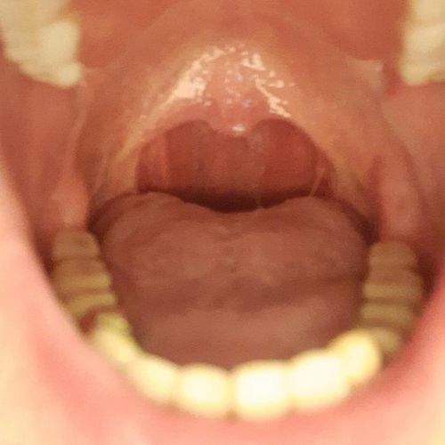 Bild eines Users zum Thema Seitenstrangangina