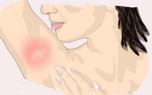 Bild eines Users zum Thema Entzündung der Achsel