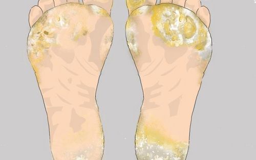 Bild eines Users zum Thema Übermäßige Verhornung