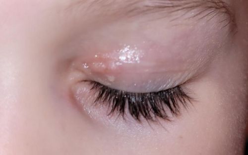 Bild eines Users zum Thema Infektionen des Auges