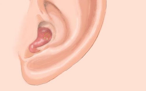 Bild eines Users zum Thema Furunkel im Ohr