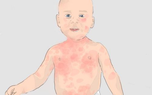Bild eines Users zum Thema Kuhmilchallergie