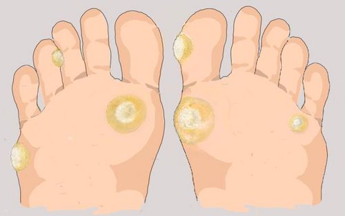 Bild eines Users zum Thema Hühnerauge