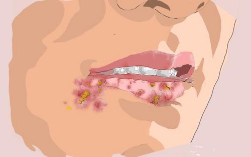 Bild eines Users zum Thema Herpes