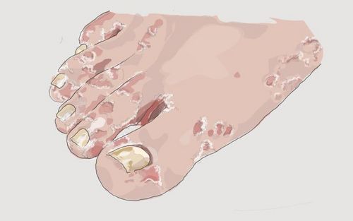 Bild eines Users zum Thema Fußpilz