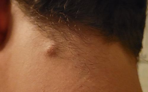 Bild eines Users zum Thema Abszess