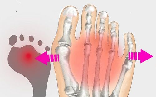 Bild eines Users zum Thema Spreizfuß