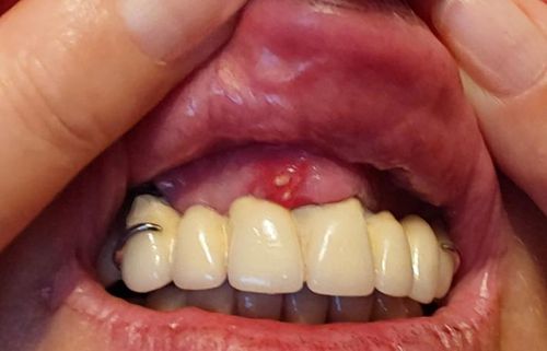 Bild eines Users zum Thema Aphthen