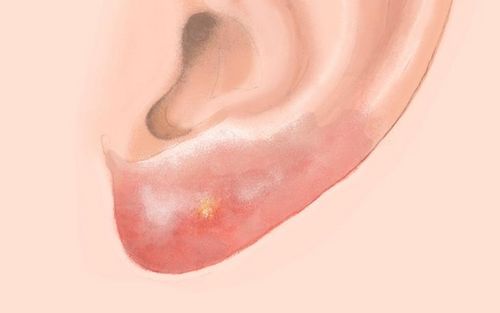 Bild eines Users zum Thema Entzündung der Ohrläppchen