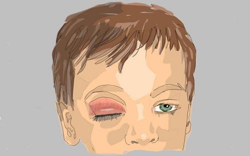 Bild eines Users zum Thema Augenlidentzündung