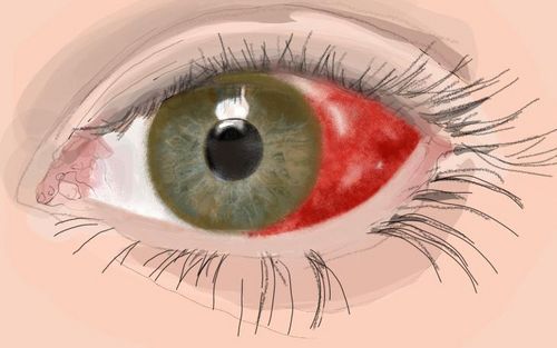 Bluterguss Im Auge Wann Zum Arzt www.docset.de
