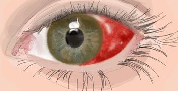 Bluterguss im Auge - Symptome