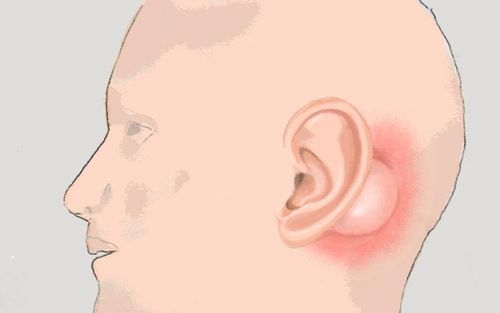 Bild eines Users zum Thema Mastoiditis