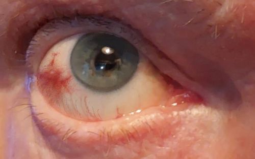 Bild eines Users zum Thema Bluterguss im Auge