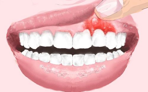Bild eines Users zum Thema Zahnfleischentzündung - Symptome, Behandlung, Medikamente & Hausmittel