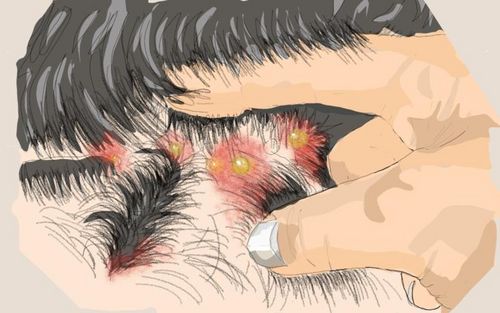 Bild eines Users zum Thema Haarbalgentzündung