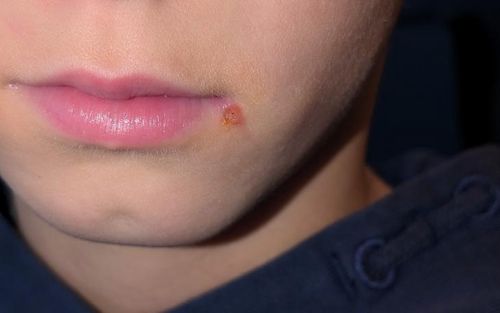 Bild eines Users zum Thema Herpes