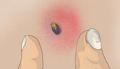 Bild eines Users zum Thema Abszess