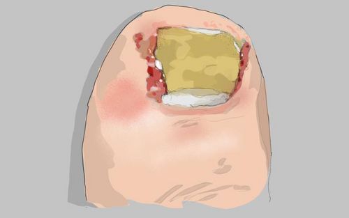 Bild eines Users zum Thema Eingewachsener Nagel