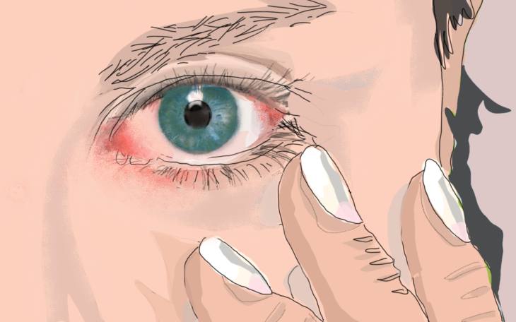 Lederhautentzündung Anzeichen